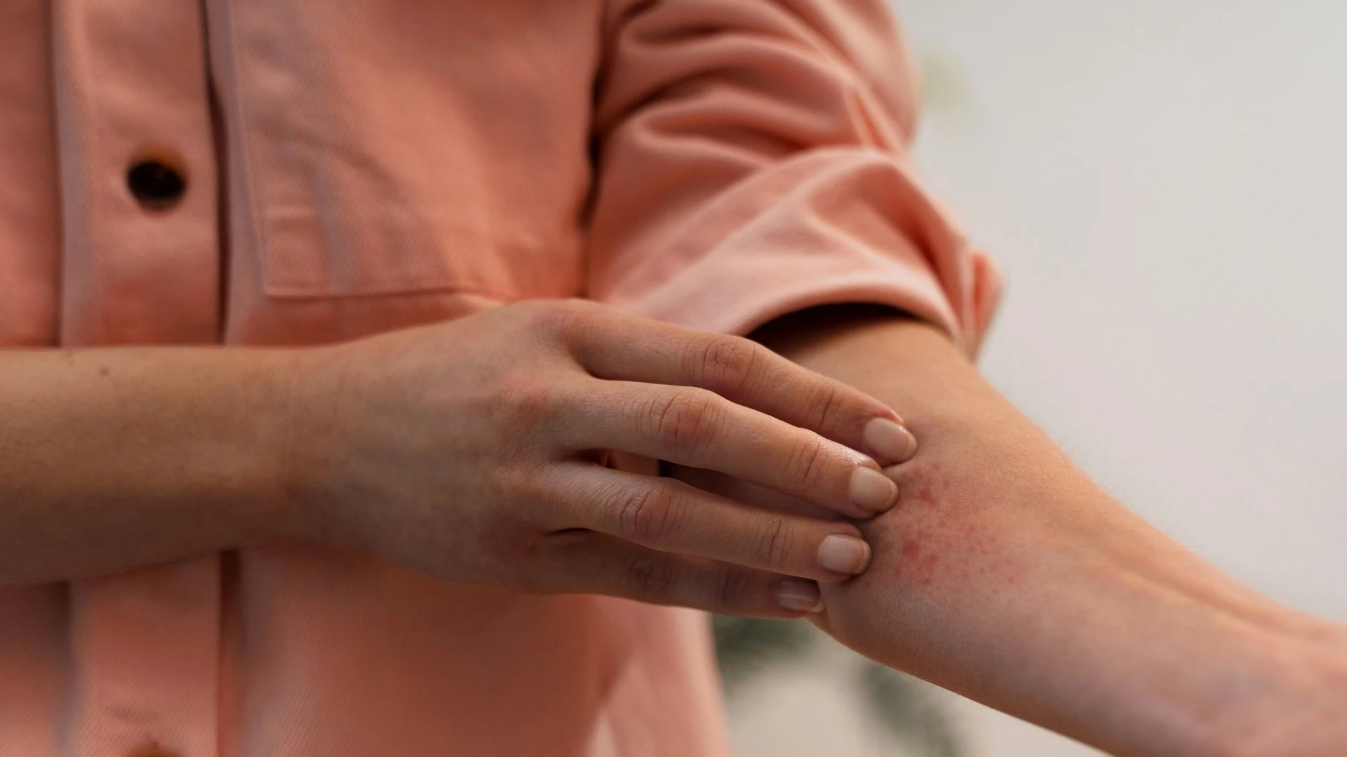 Dermatitis de Contacto