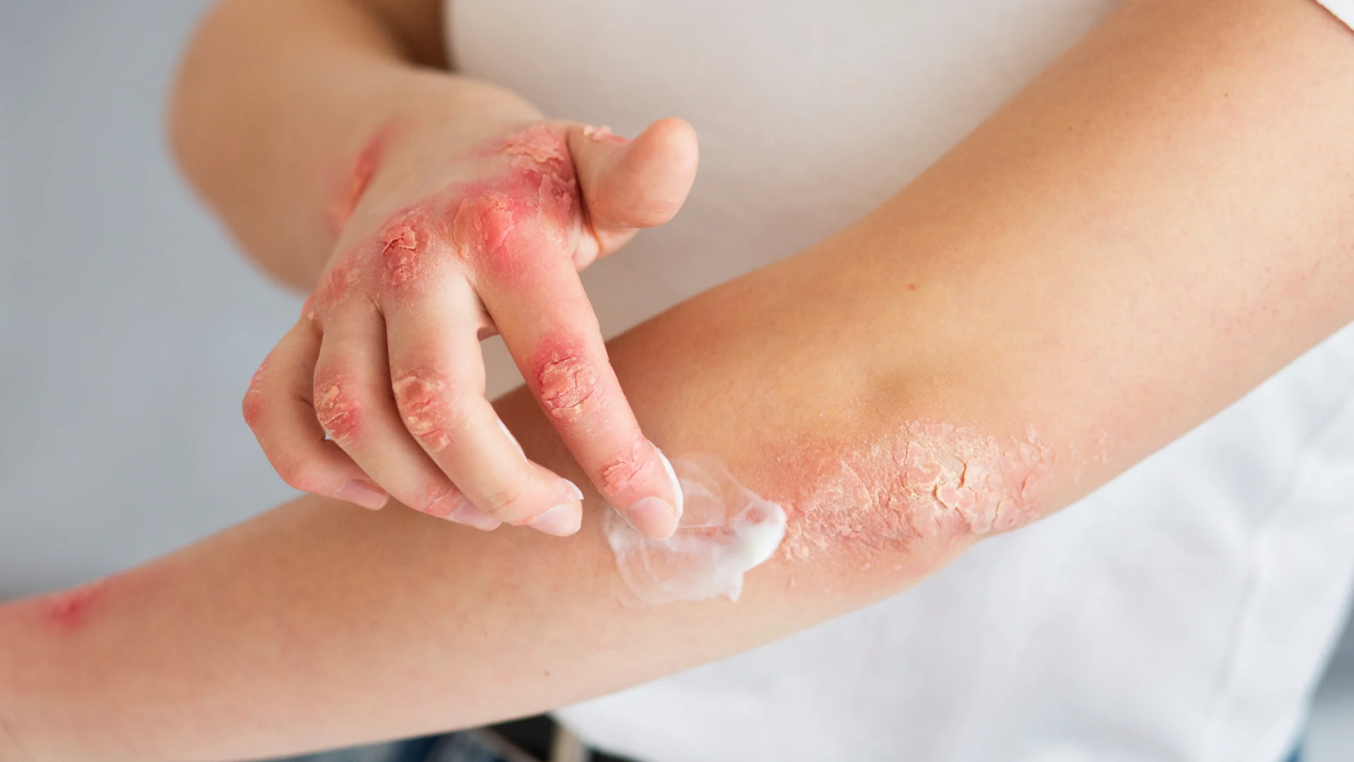 Dermatitis Atópica