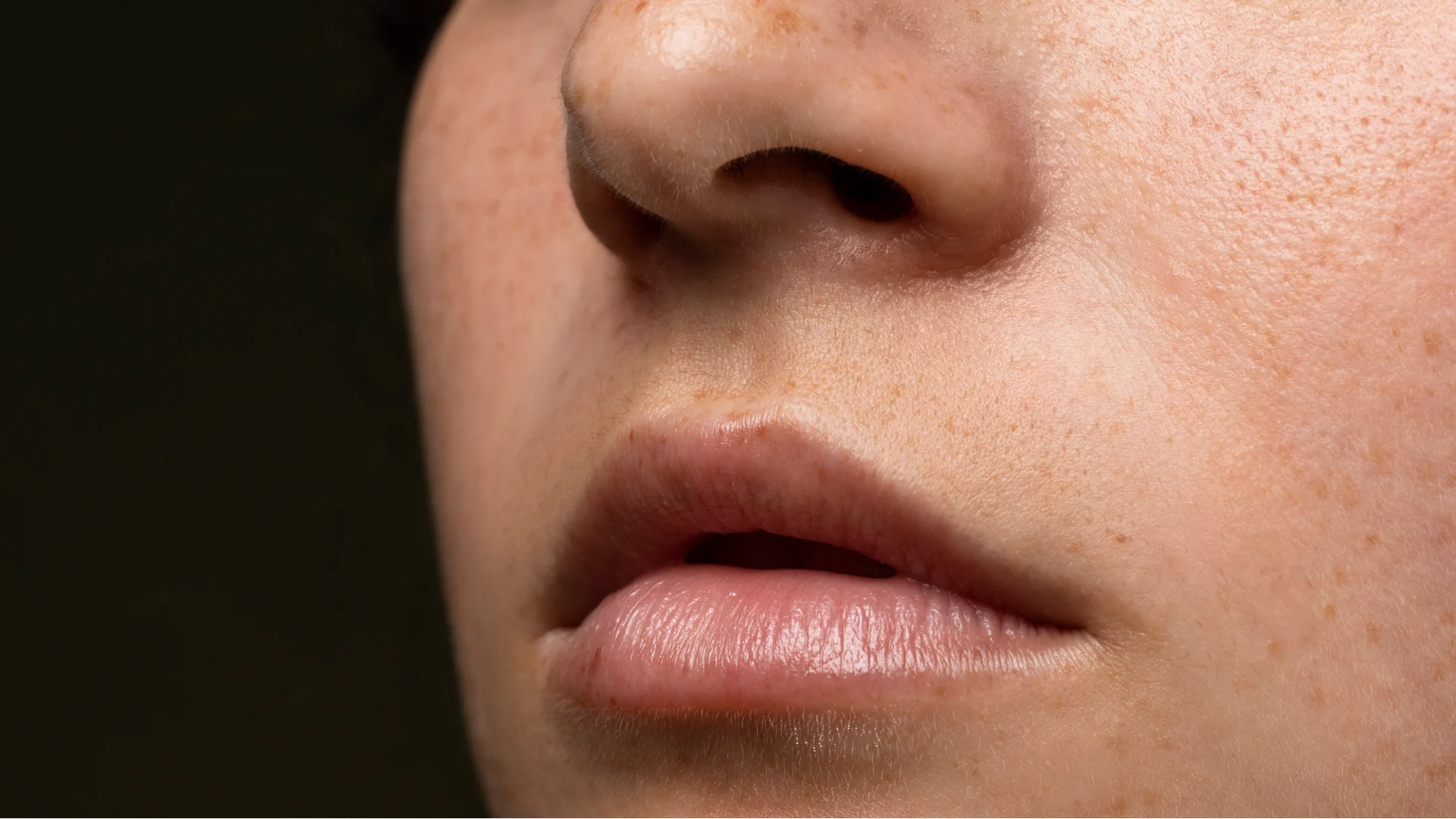 Dermatitis Perioral