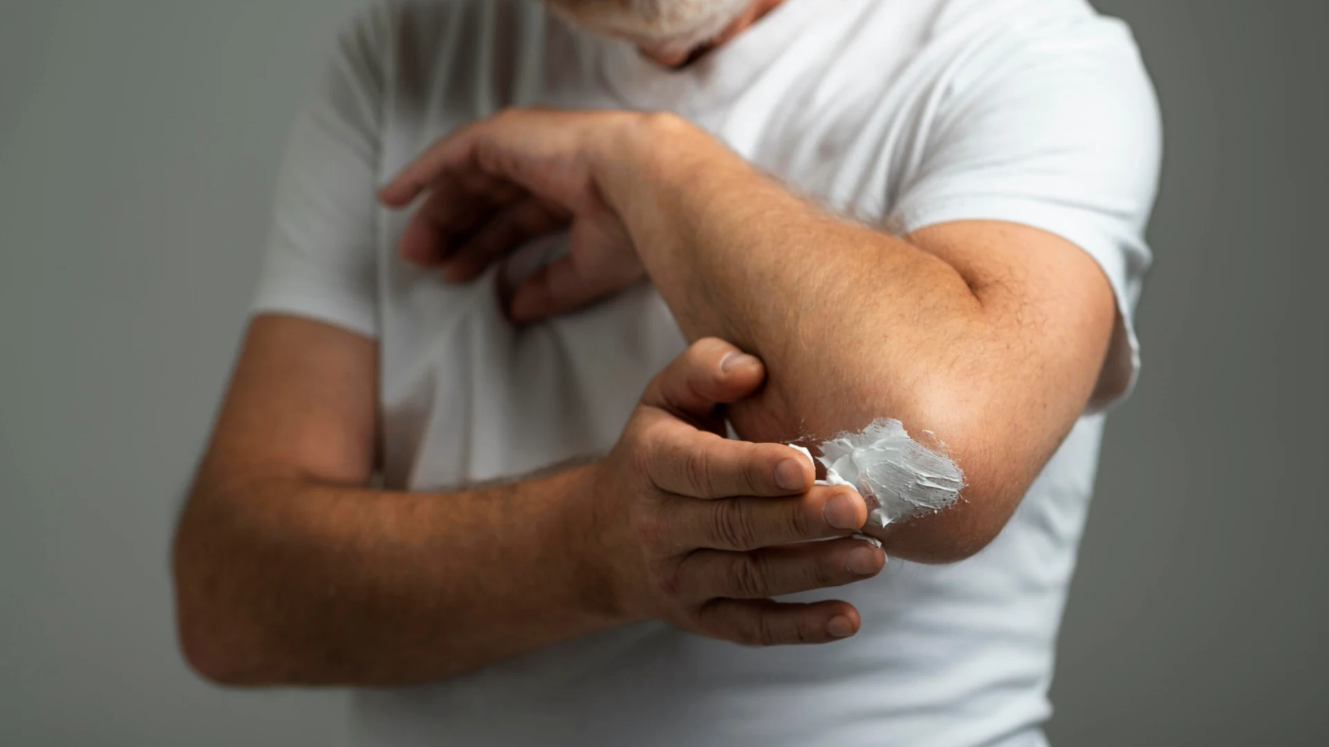 Dermatitis Nummular
