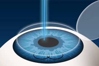 lasik-enhancement-330x220
