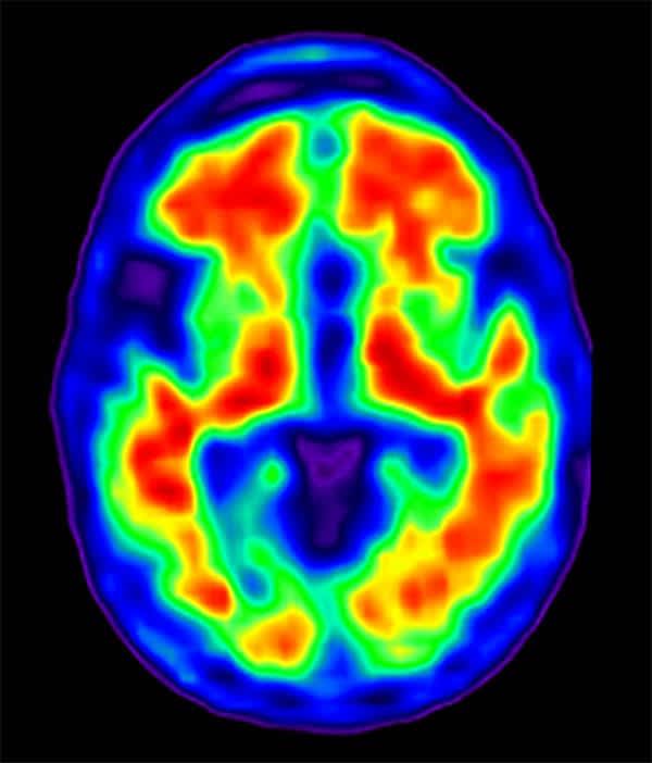 pet-scan-2-600-2018-04