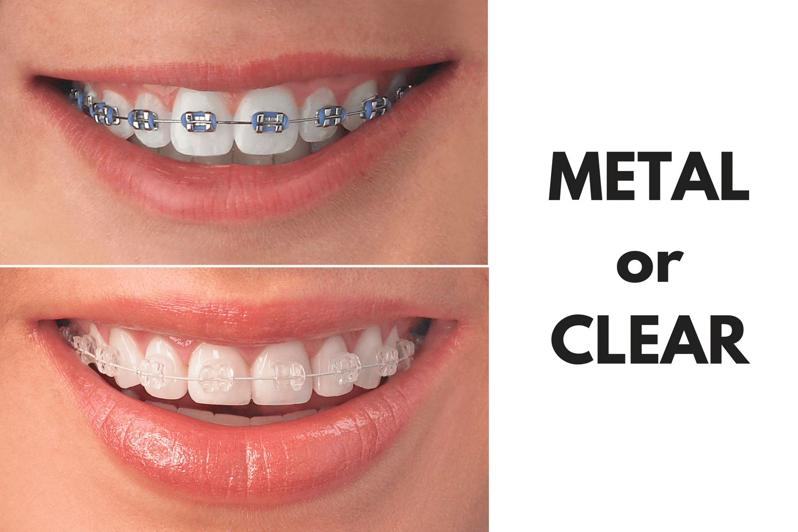 02-Metal-or-Clear