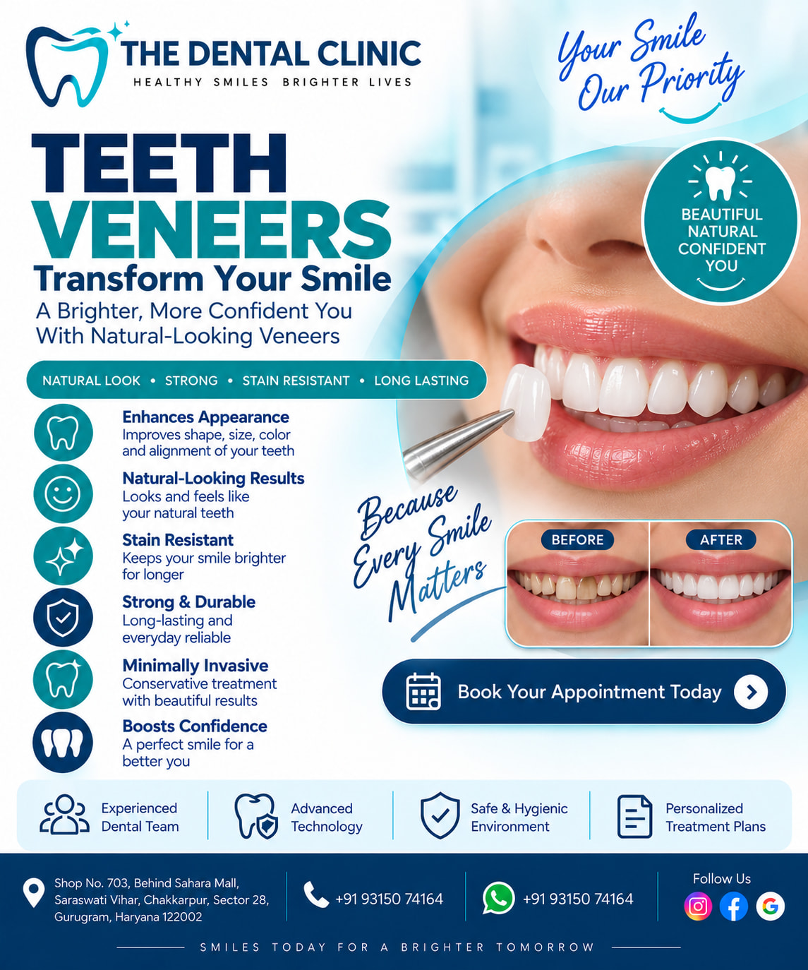 Teeth Veneers