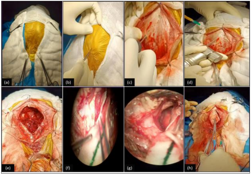 Transfrontal craniotomy for surgical removal of frontal meningioma in a canine patient: A case study