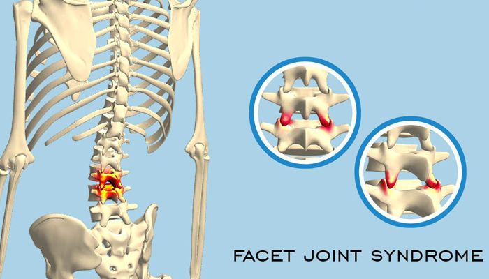 Facet Syndrome