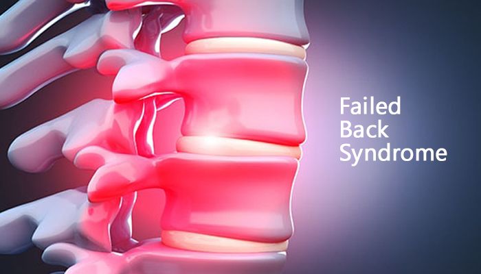 Failed Back Syndrome