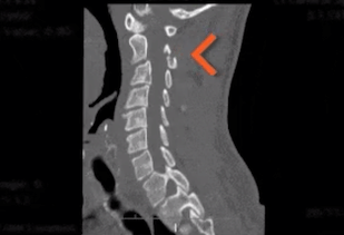 gif of an arrow pointing to a spine that looks odd