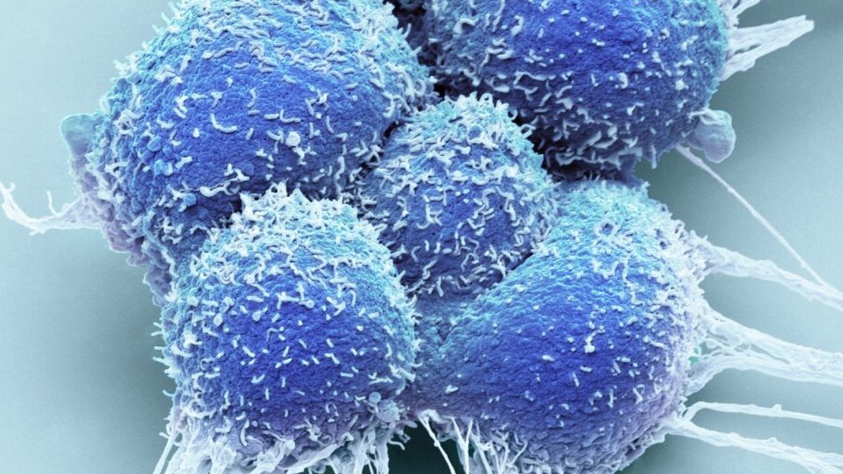 New Data Could Sway Prostate Focal Therapy Debate New Data Could Sway Prostate Focal Therapy Debate - prostate focal therapy