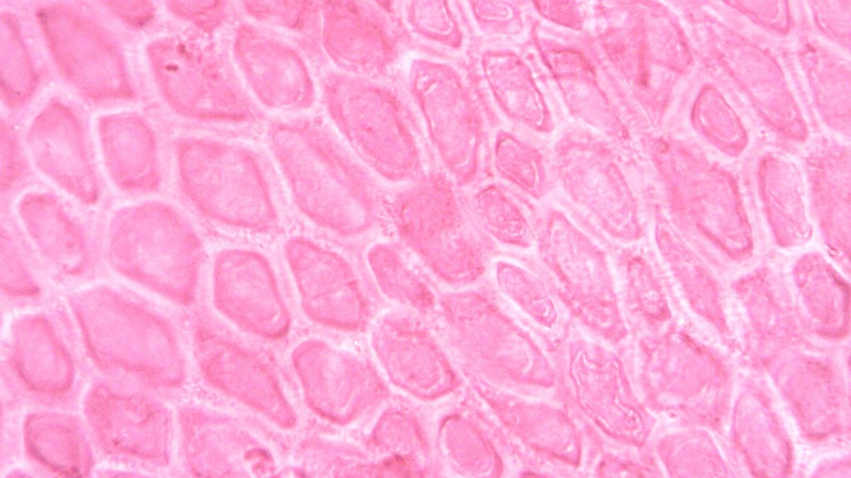 Breast cancer frequently targets bones - bone metastasis