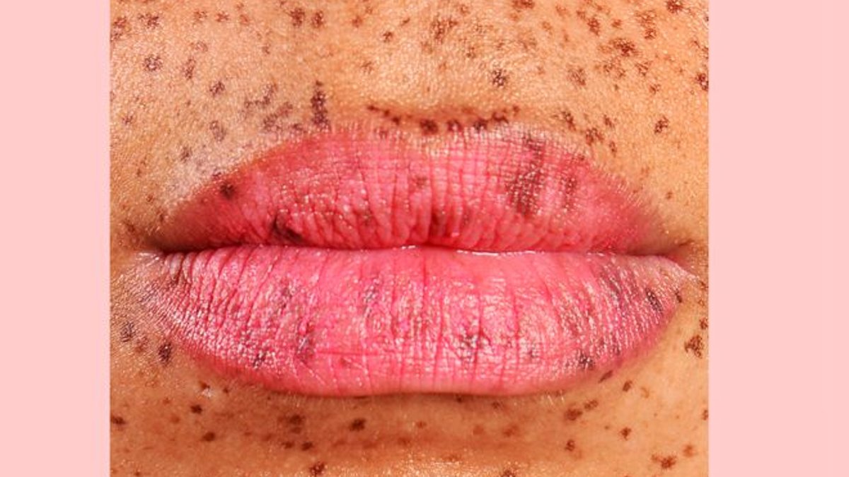 Quick fixes for cracked lip corners - cracked lip corners