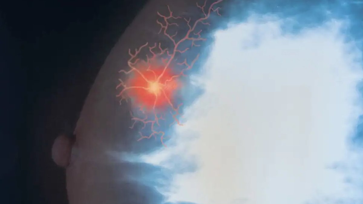 Breast Cancer Patients Guide to Sub Q Injections - breast cancer