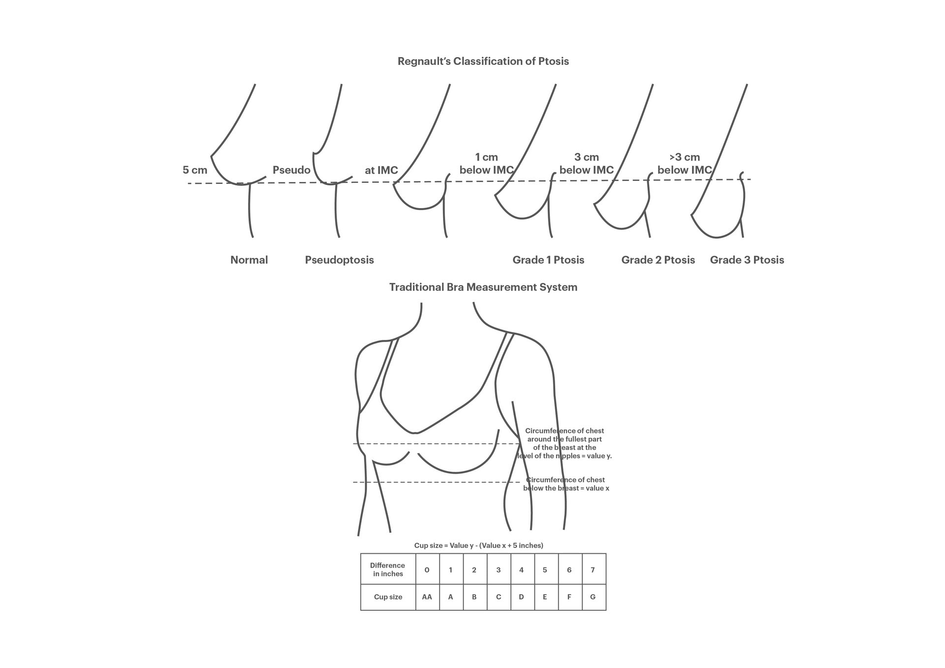 Regnault’s Classification of Ptosis and the Traditional Bra Measurement System