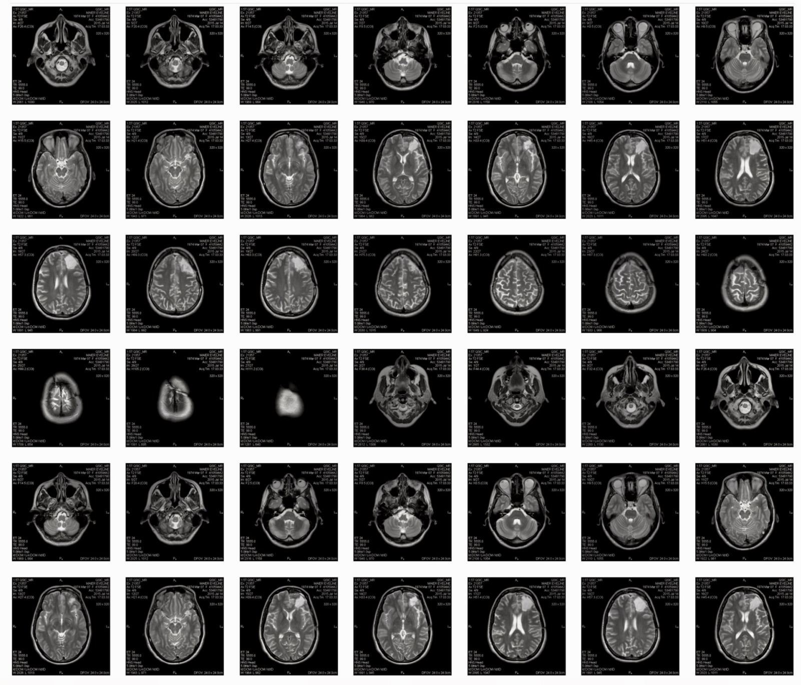 Evelin Maier's neurological MRI scans of 2014/2015. 