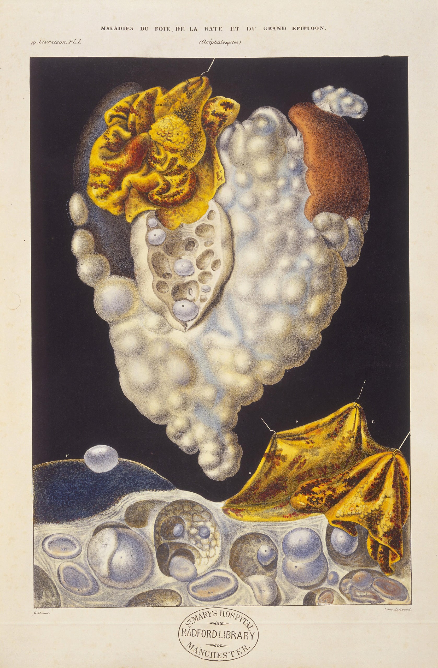 A hand-coloured lithograph depicting a cystic liver, with pearlescent colouring. 