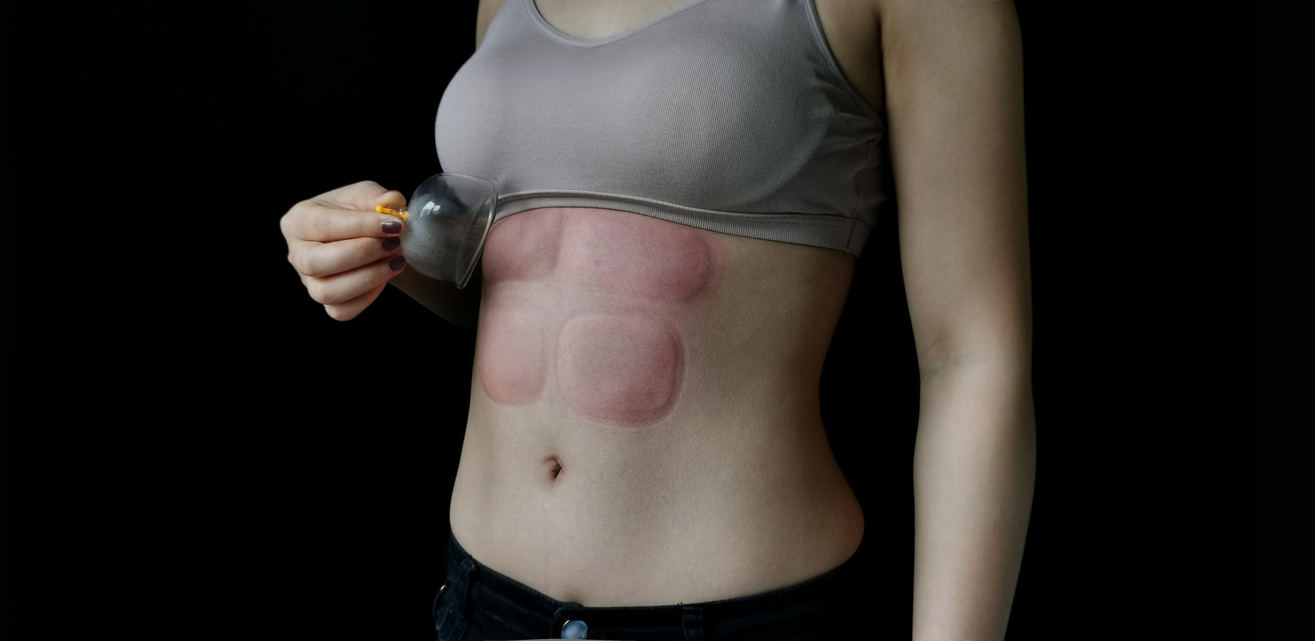 Cupping therapy on abs