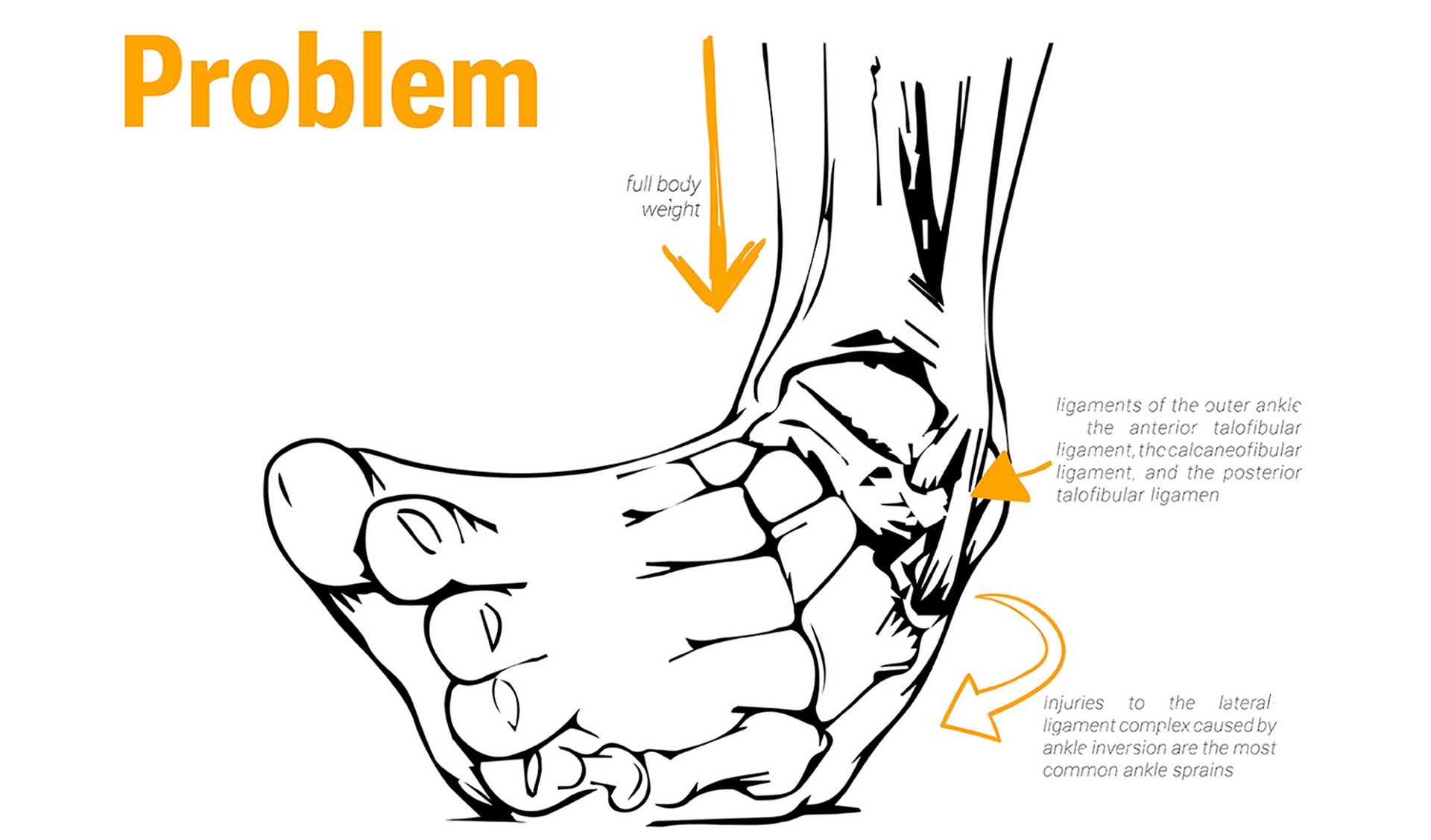 85% of ankle injuries are lateral ankle sprains