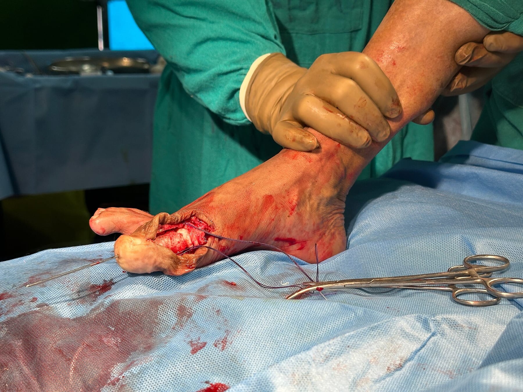 A 3D-printed biodegradable bone scaffold in clinical use in Assam - representative image, not the Ceramat project