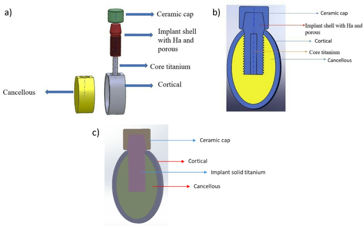 Diagram of a bi-layer dental implant design - research illustration