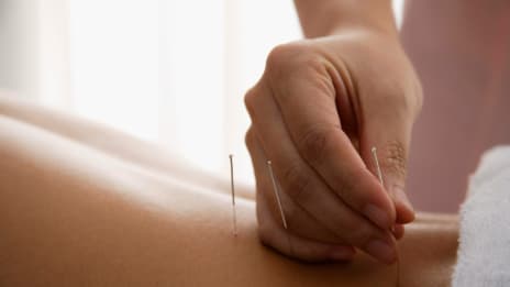 Az akupunktúra jelentése és hatásai