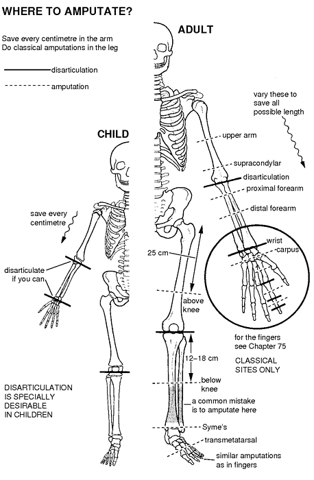 The general method for amputations