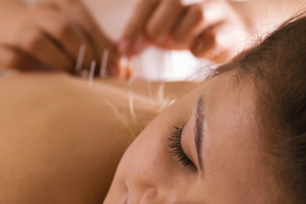 Acupuncture