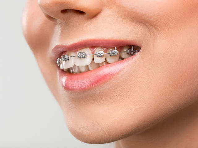 Metal Braces in Dubai: A Reliable Way to Straighten Teeth