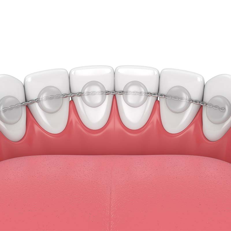 A fixed retainer bonded to the back of a patient&rsquo;s teeth