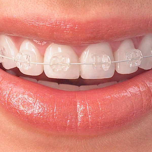 Closeup of clear ceramic braces on a patient&rsquo;s teeth