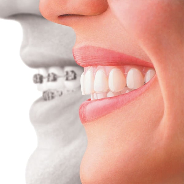 Profile picture comparing nearly invisible Invisalign tray to metal braces