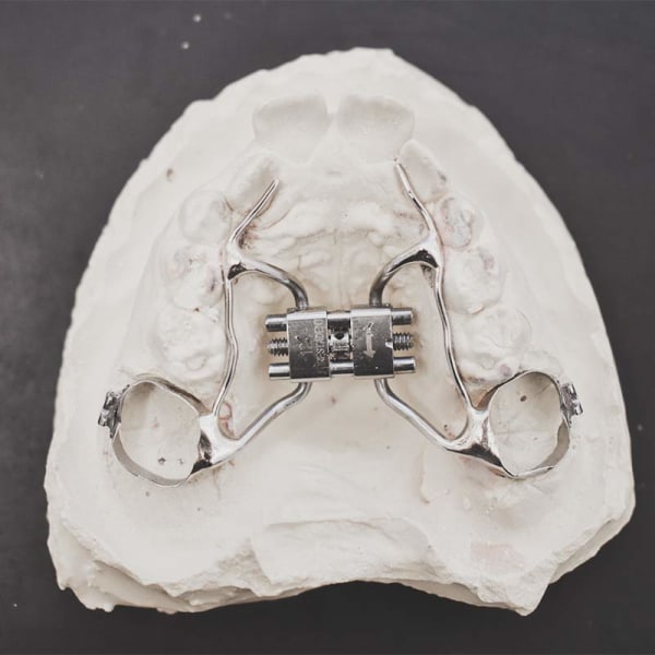 A metal rapid palate expander on a dental model