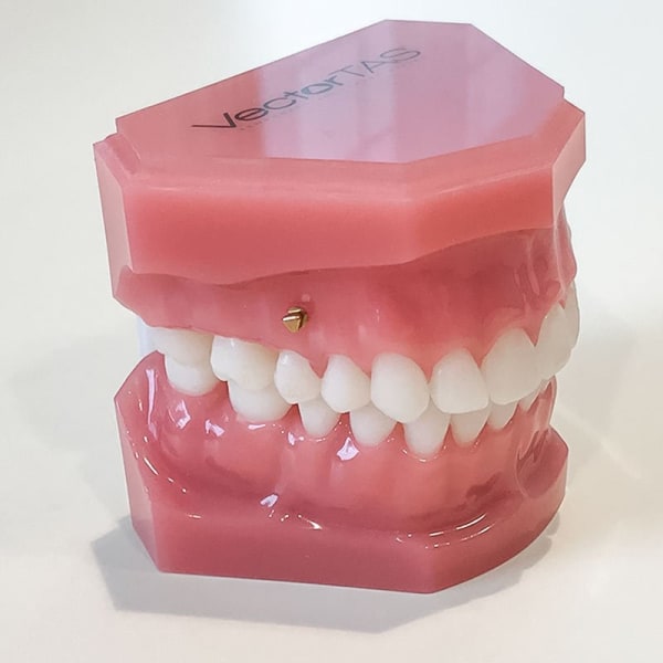 Temporary anchorage device shown on a dental model