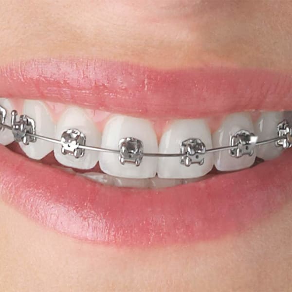 Closeup of metal braces on a patient&rsquo;s teeth