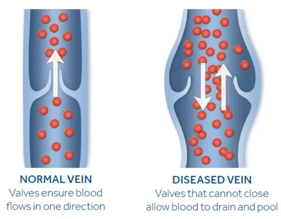 Varicose Veins