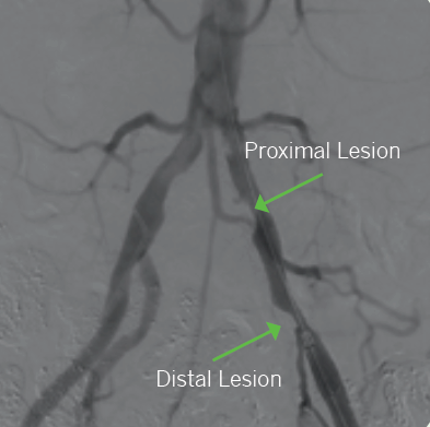 Pre-atherectomy