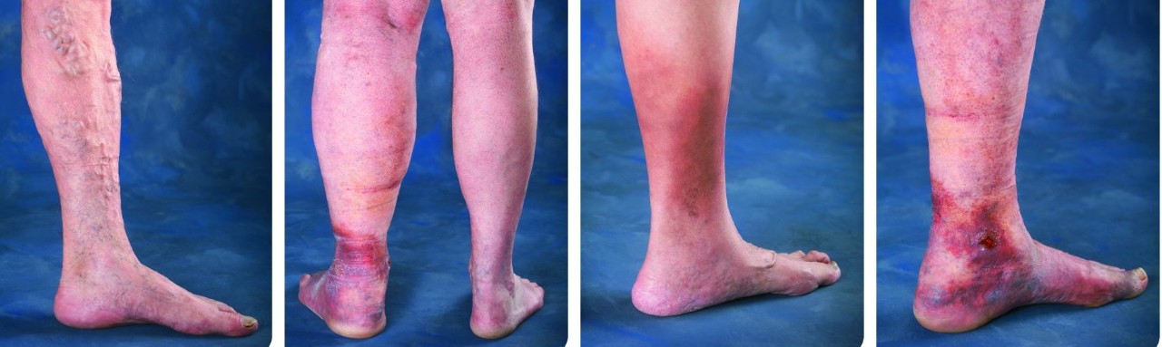 The stages of Chronic Venous Insufficiency&nbsp;