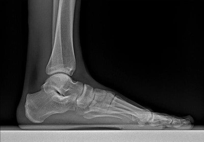 Tendinite vs Me - K.O.