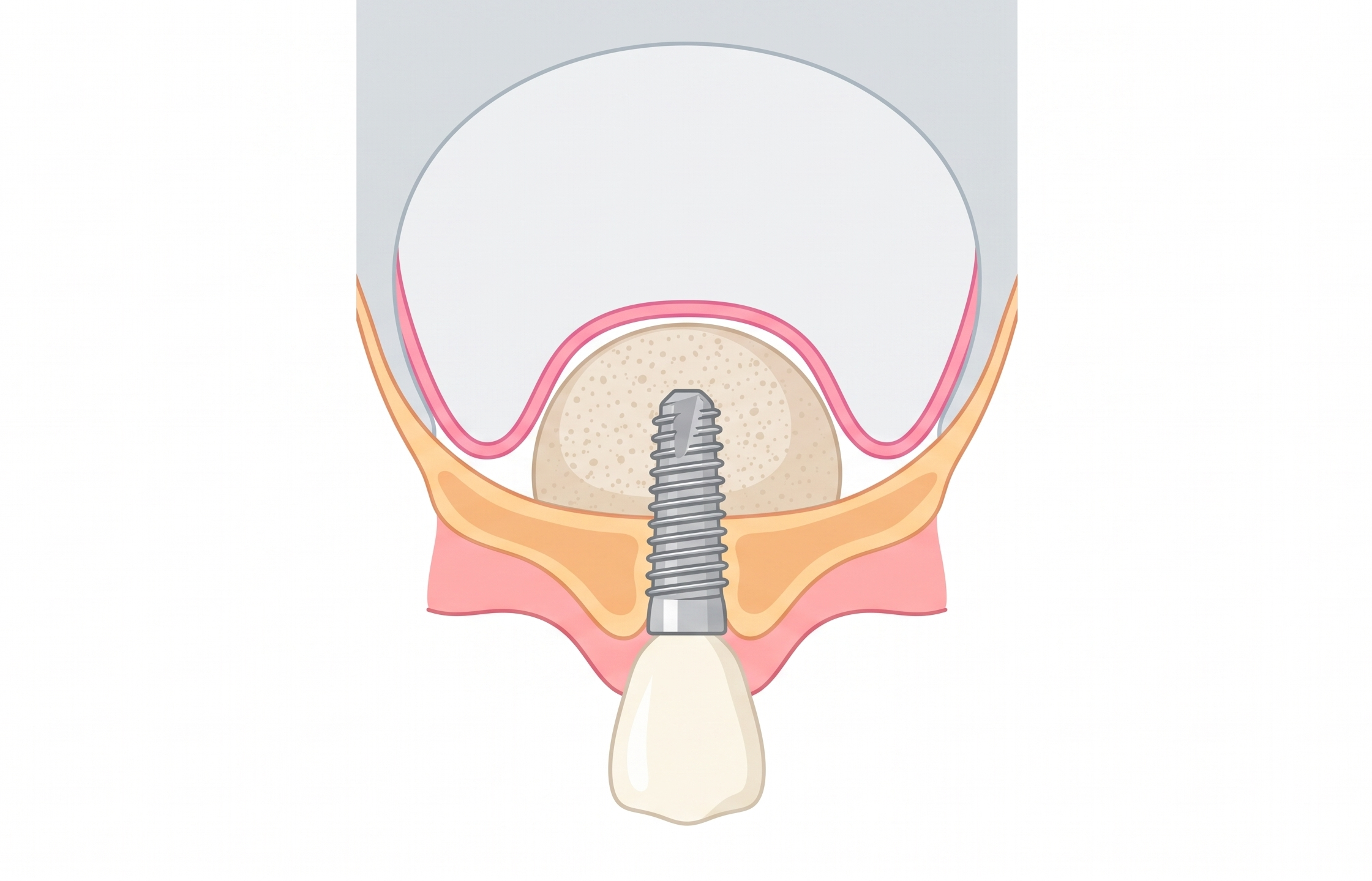 안산 단원구 임플란트 상담에서 설명하는, 상악동 아래 얇아진 잇몸뼈에 뼈이식재를 돔 모양으로 채우고 임플란트를 심은 위턱 단면