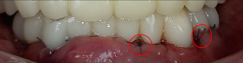발치 당일 임플란트를 심고 임시 치아를 연결한 앞니 부위의 구강 내 근접 모습
