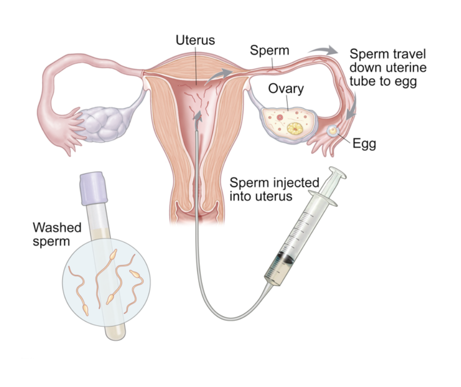 Intrauterine Insemination Iui What It Is And How It Works Androcare Fertility Hospital 