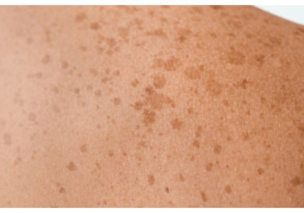 Le cancer de la peau : une maladie professionnelle