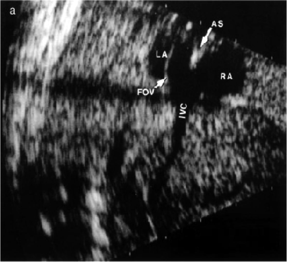 Figur 4. Ultralyd av 23 ukers foster viser en tynn abdominal vena cava inferior (IVC) som utvides mot venstre like før innmunningen i hjertet. Her treffer ductus venosus blodet med høy hastighet og fortsetter oppover langs foramen oval klaffen (FOV) med retning mot venstre atrium (LA), mens blodet fra abdomen løper noe til høyre i retning høyre atrium (RA). Blodsøylen splittes ikke før den når crista dividens av atrie-septum (AS).  I fosterlivet er altså IVC dedikert begge atrier.