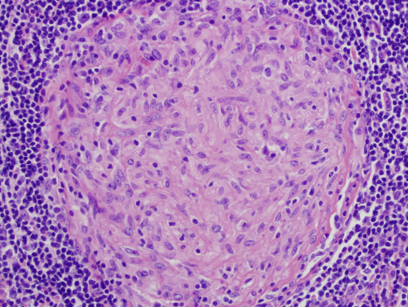 A granuloma found inside an infected patient's lymph node.