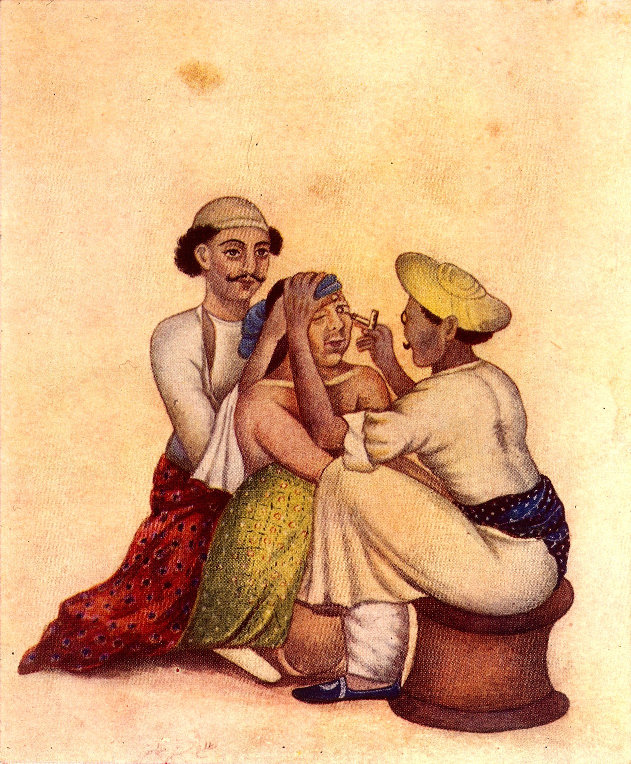 An illustration of couching, an ancient treatment used to shift the position of a cataract.