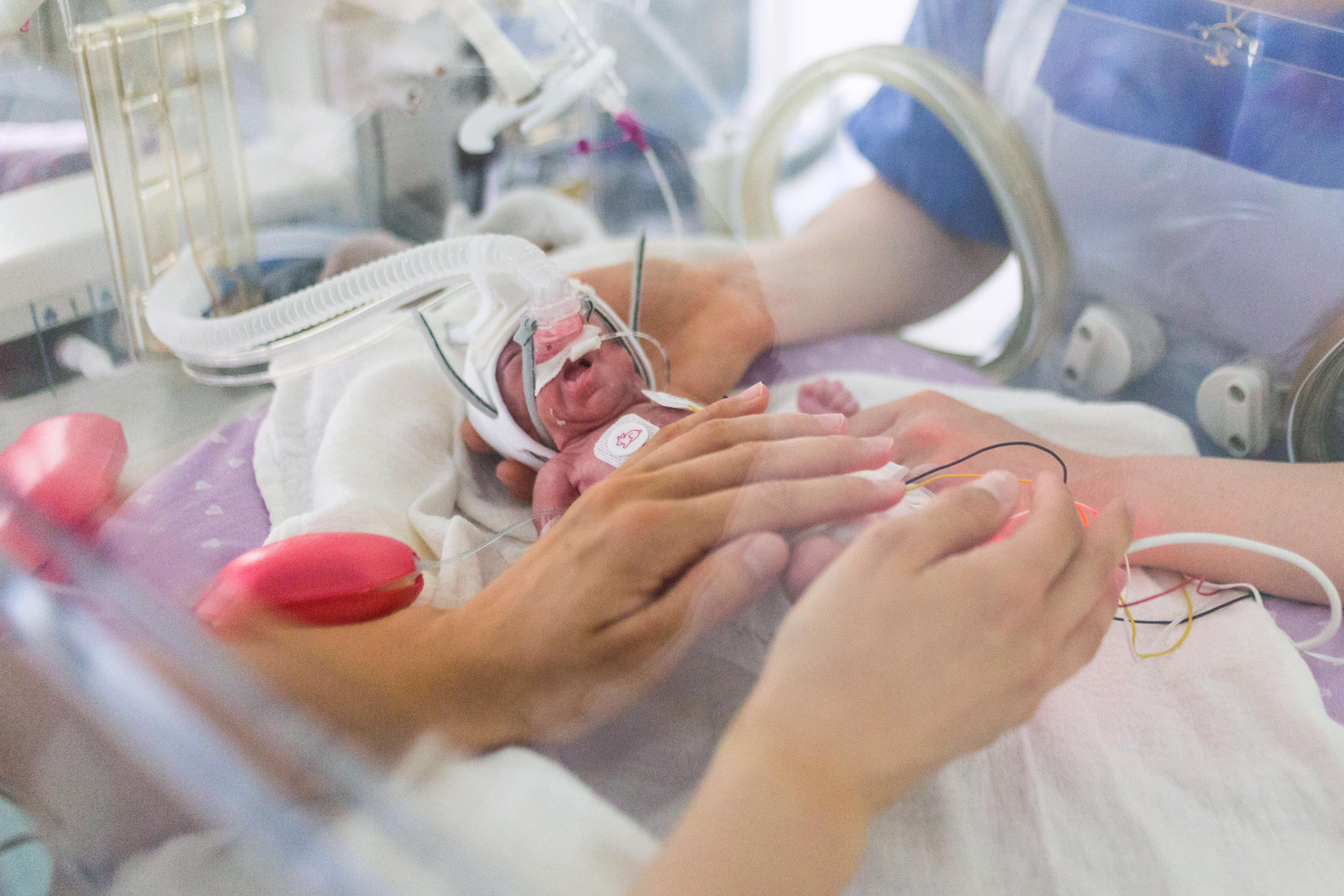 A premature infant draws oxygen from a respirator at the Centre Hospitalier Universitaire in Bordeaux.