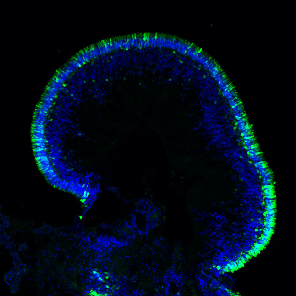 A retinal organoid produced using lab-made retinal tissues built from patient cells.