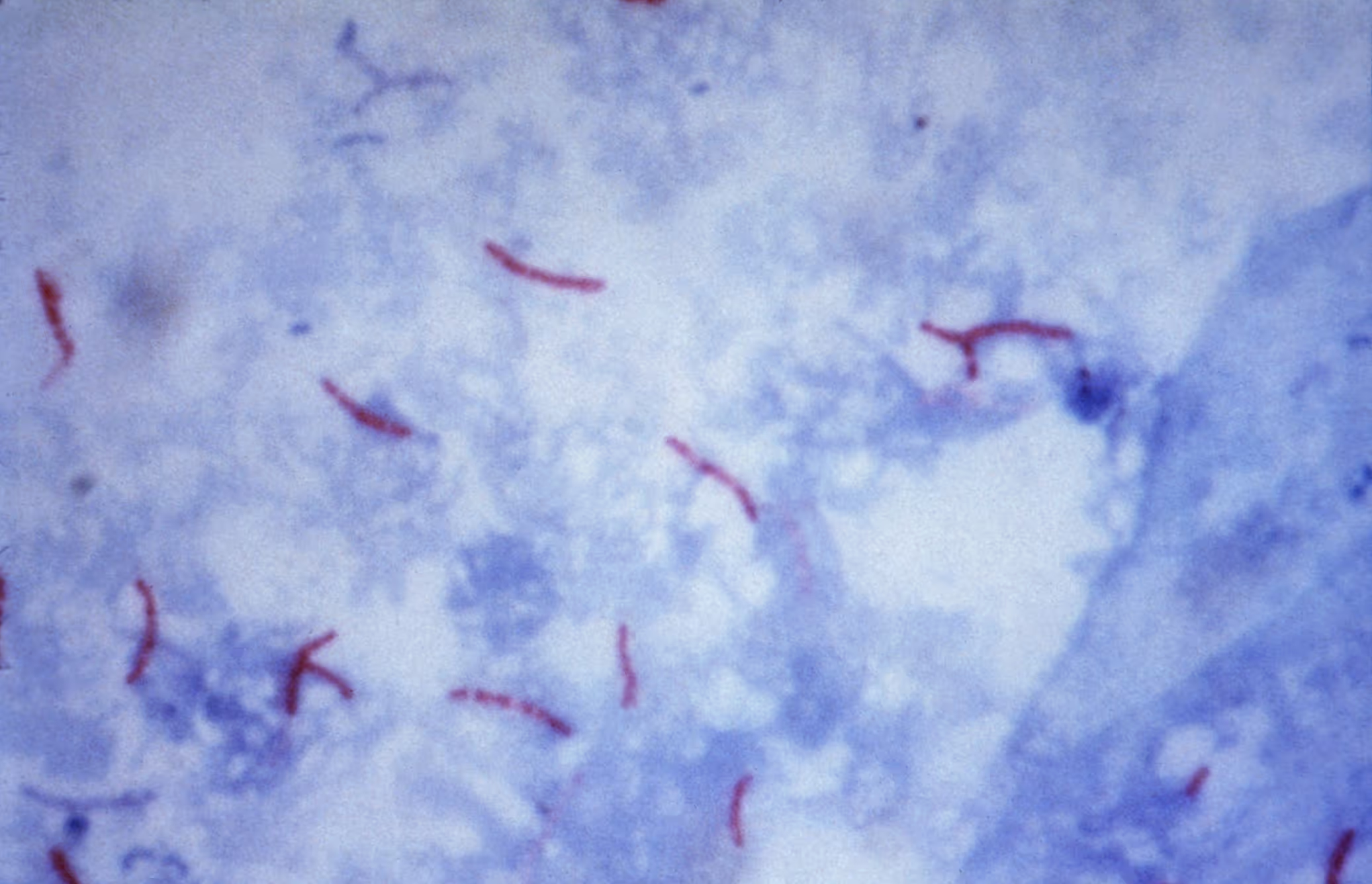 A sputum test stain for M. tuberculosis.