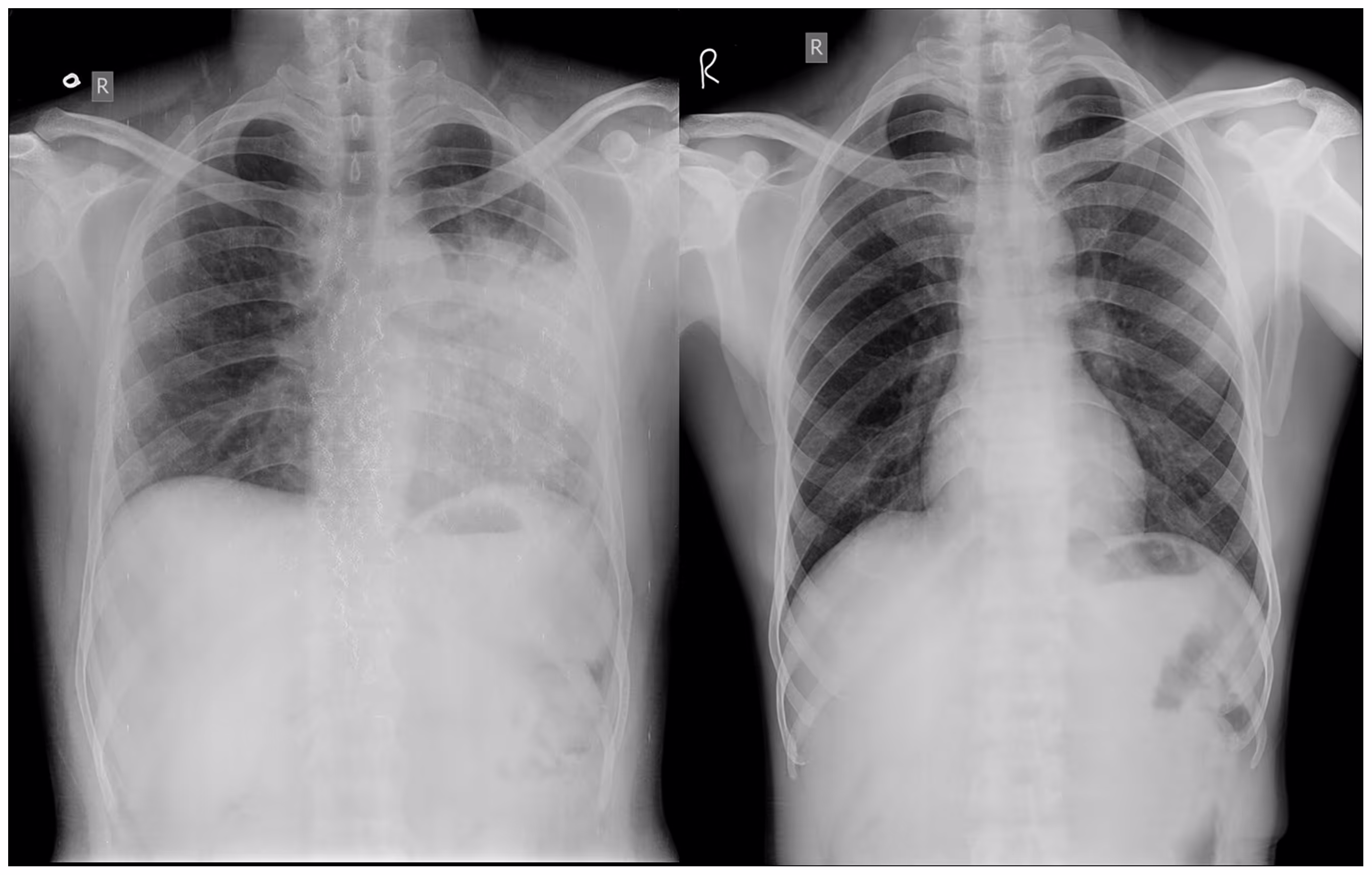Two chest x-rays showing the lungs of a TB patient and a healthy individual.