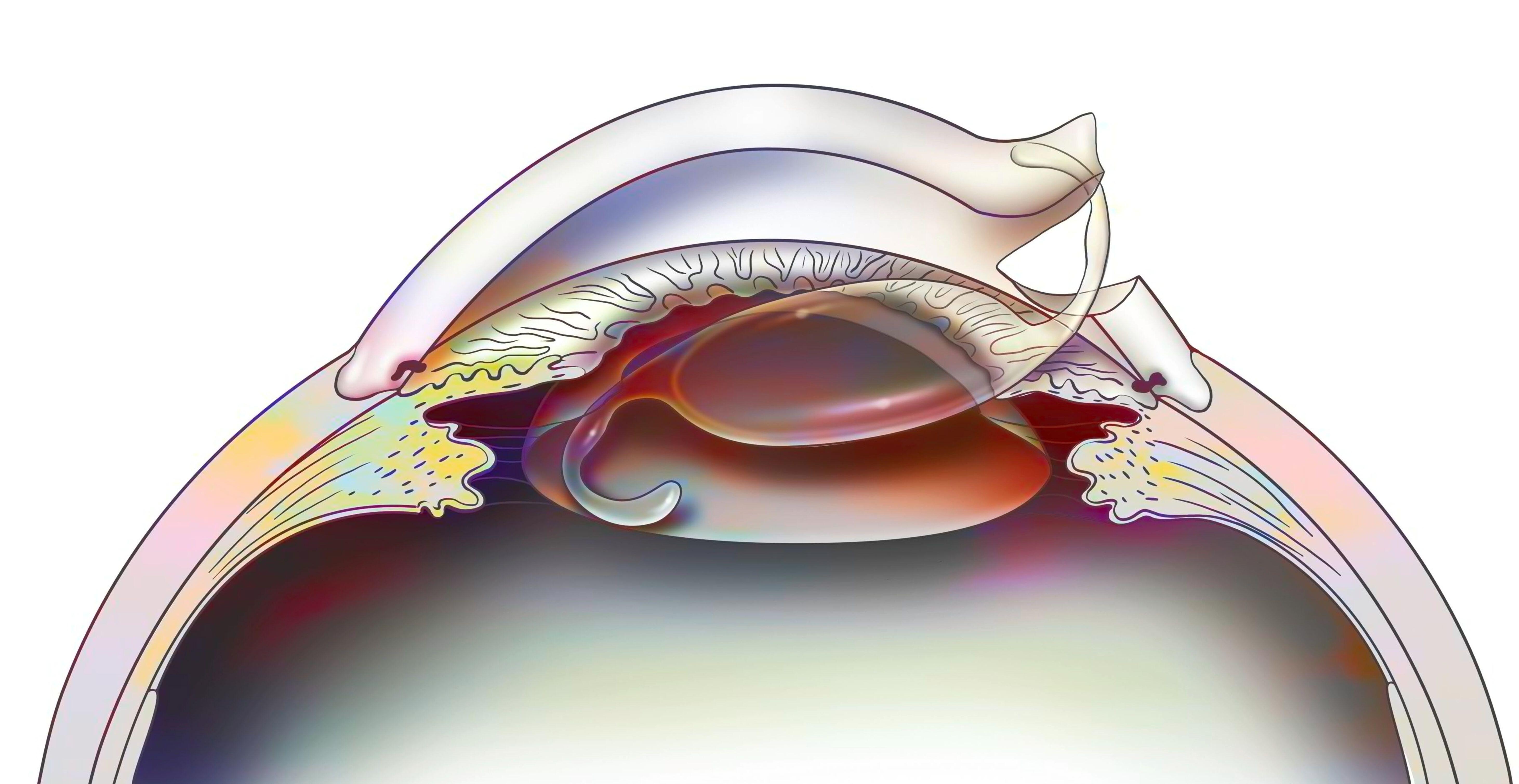A diagram showing the placement of an intraocular lens into the eye after cataract removal.
