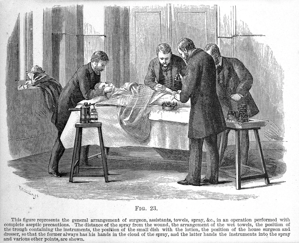 Surgeons use the Lister carbolic spray during surgery (1882)